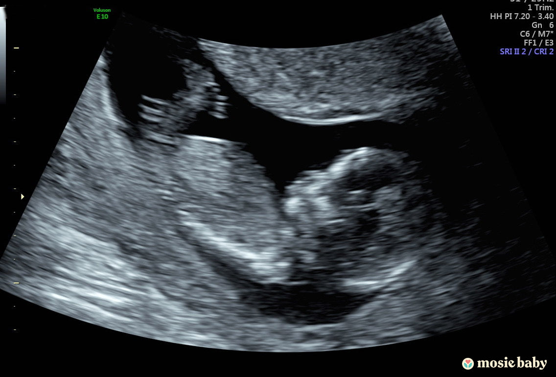 Sonogram of Mosie Baby
