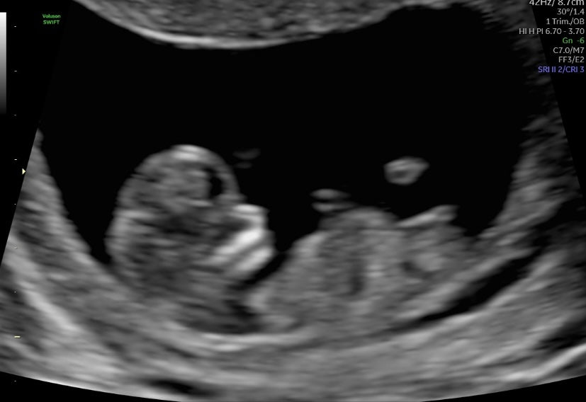 Ultrasound Pregnancy