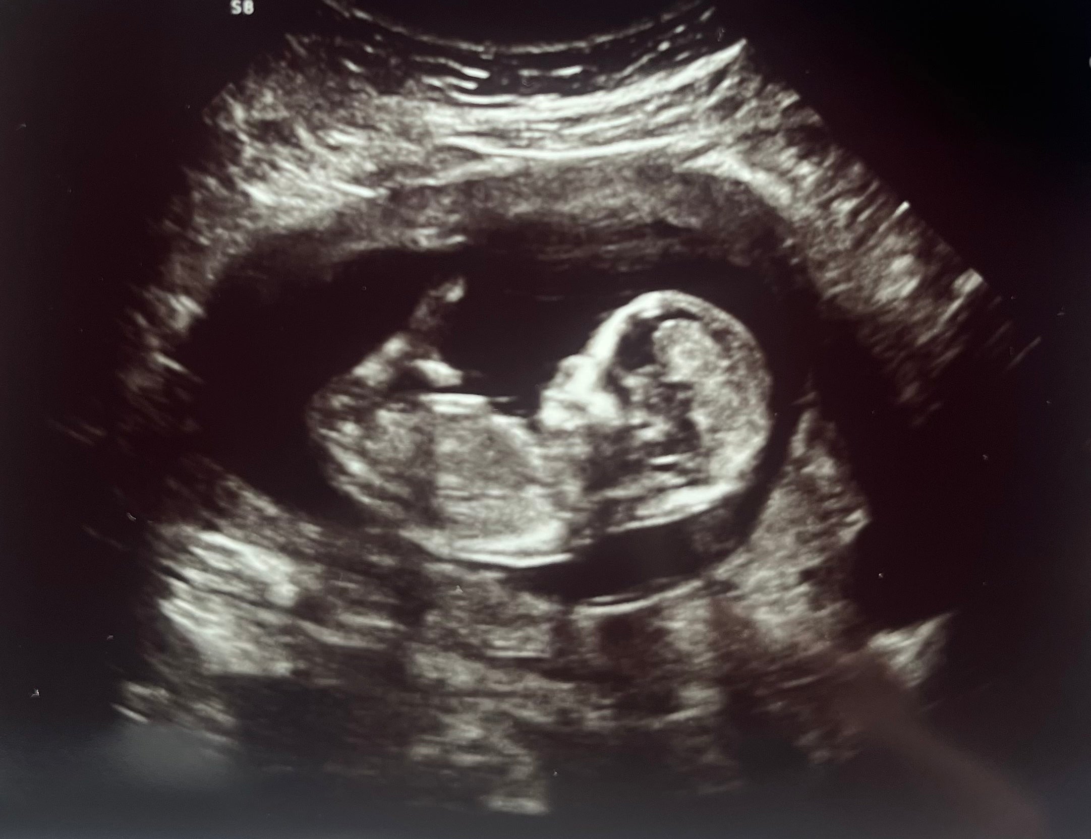 They Were Shocked After Conceiving on the First Try